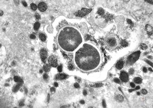 M,44y. | ulcus penis - phagocytosed microbes